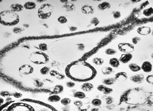 cytomegalovirus - pneumonia cytomegalovirus - pneumonia